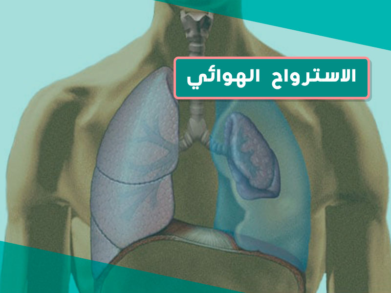 الاسترواح الهوائي