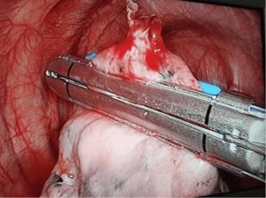 المنظار الجراحي لاستئصال مصدر تسريب الهواء